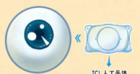 近视手术真的安全吗？医生终于说出了真相