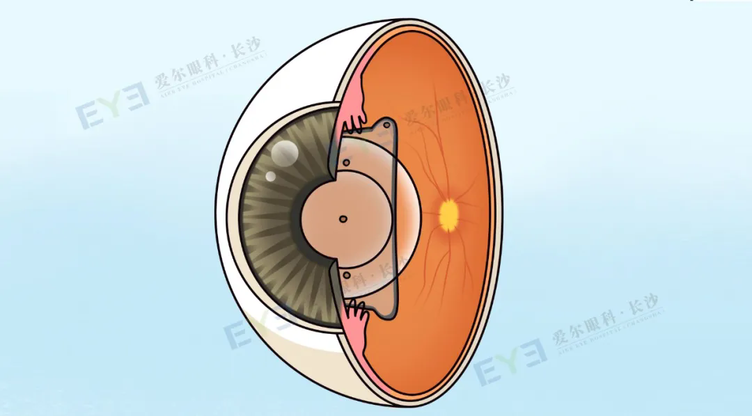 ICL晶体植入手术后视力会「反弹」吗？医生揭秘3大关键因素