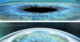 戴隐形眼镜对全飞秒4.0手术有影响吗？