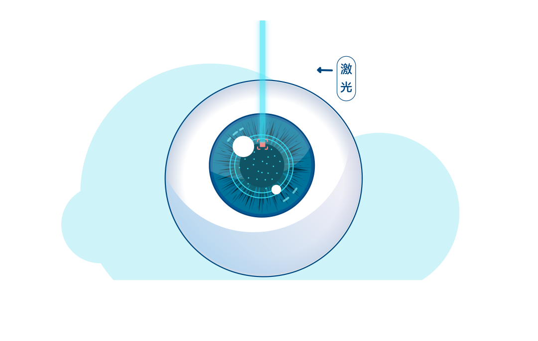 大于35岁可以做哪种近视手术？