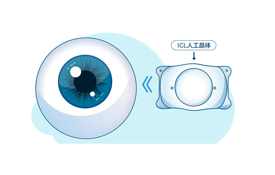 做近视手术，度数越高费用越贵？